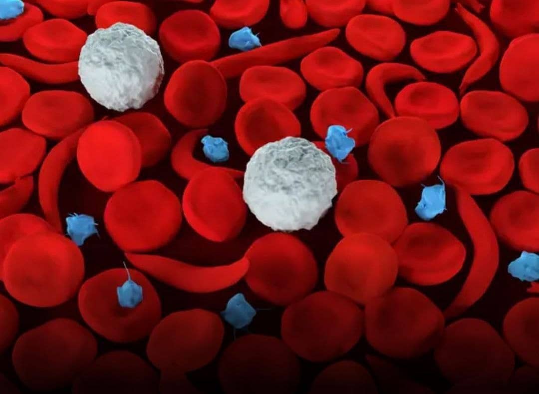 U.S. agency approves gene-editing treatments for sickle cell disease